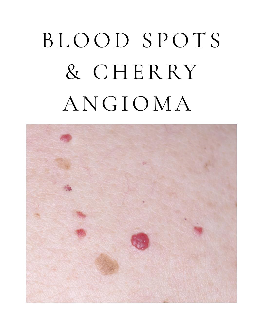 Blood Spots